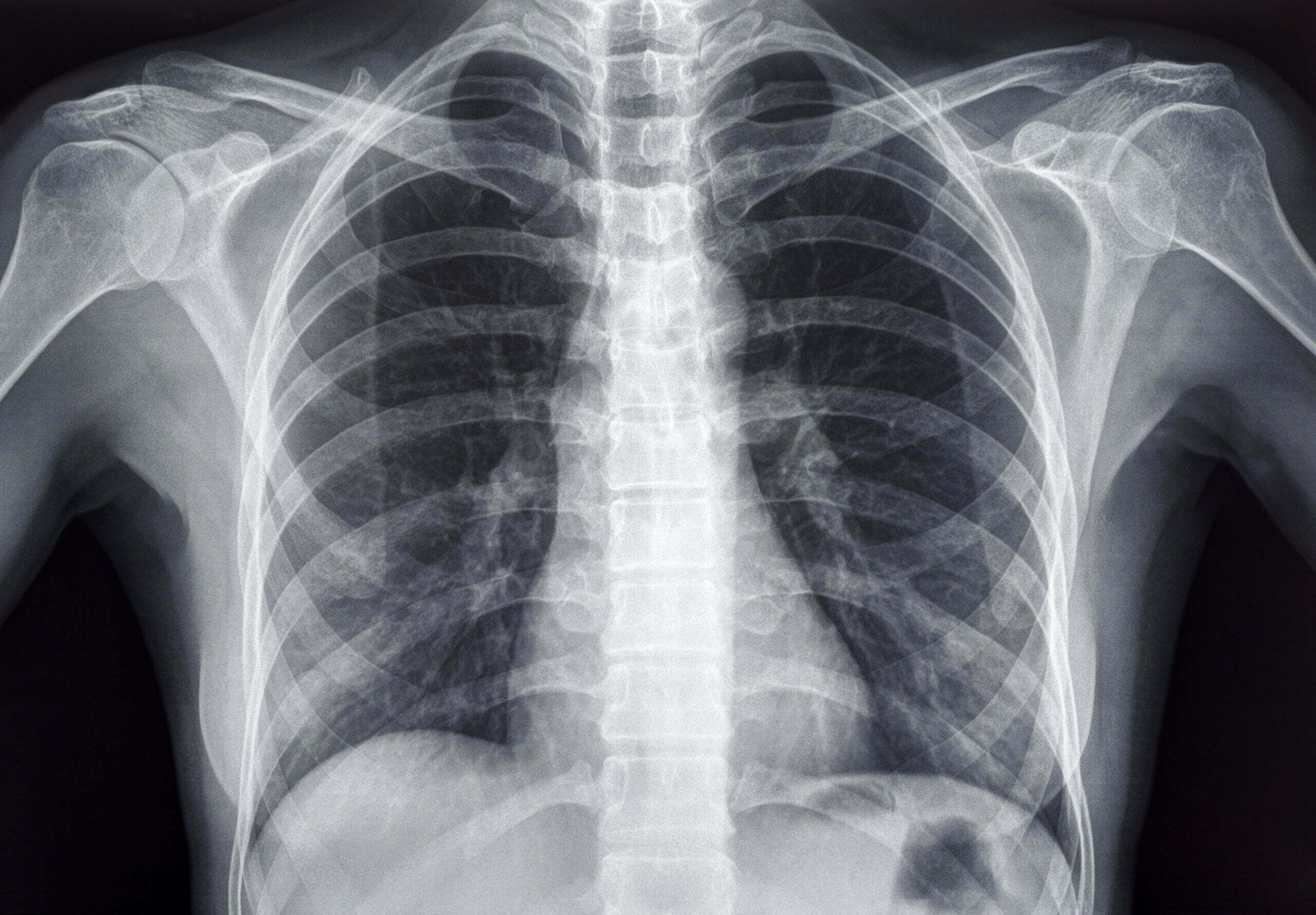 respiratory dust extraction